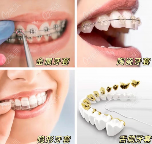牙齿矫正带什么,牙齿矫正带什么材料的性价比高,效果好